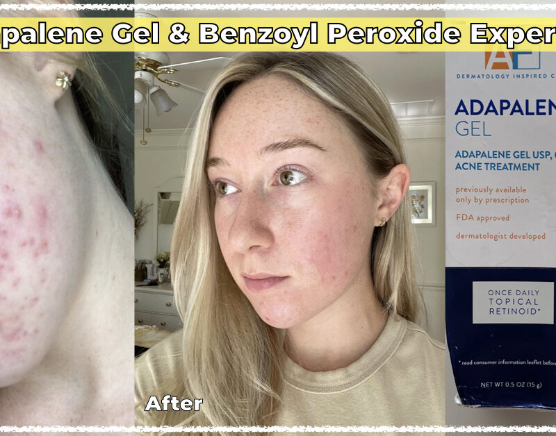 how i cleared my skin with adapalene gel and benzoyl peroxide